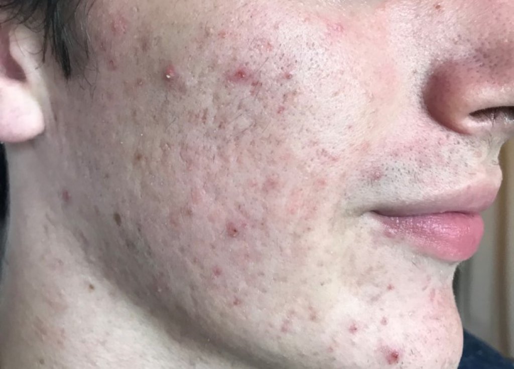 traitement des cicatrices par peeling, led, laser