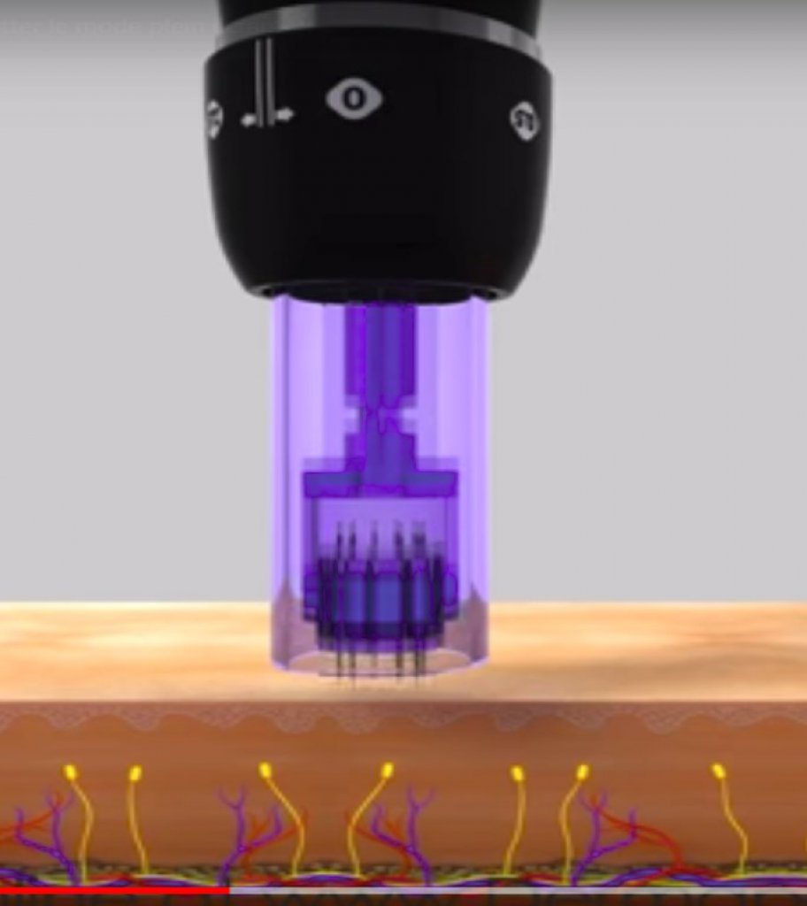 dermapen